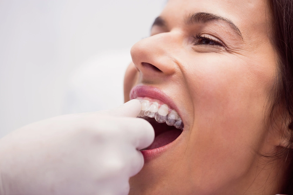 Aligners and Braces