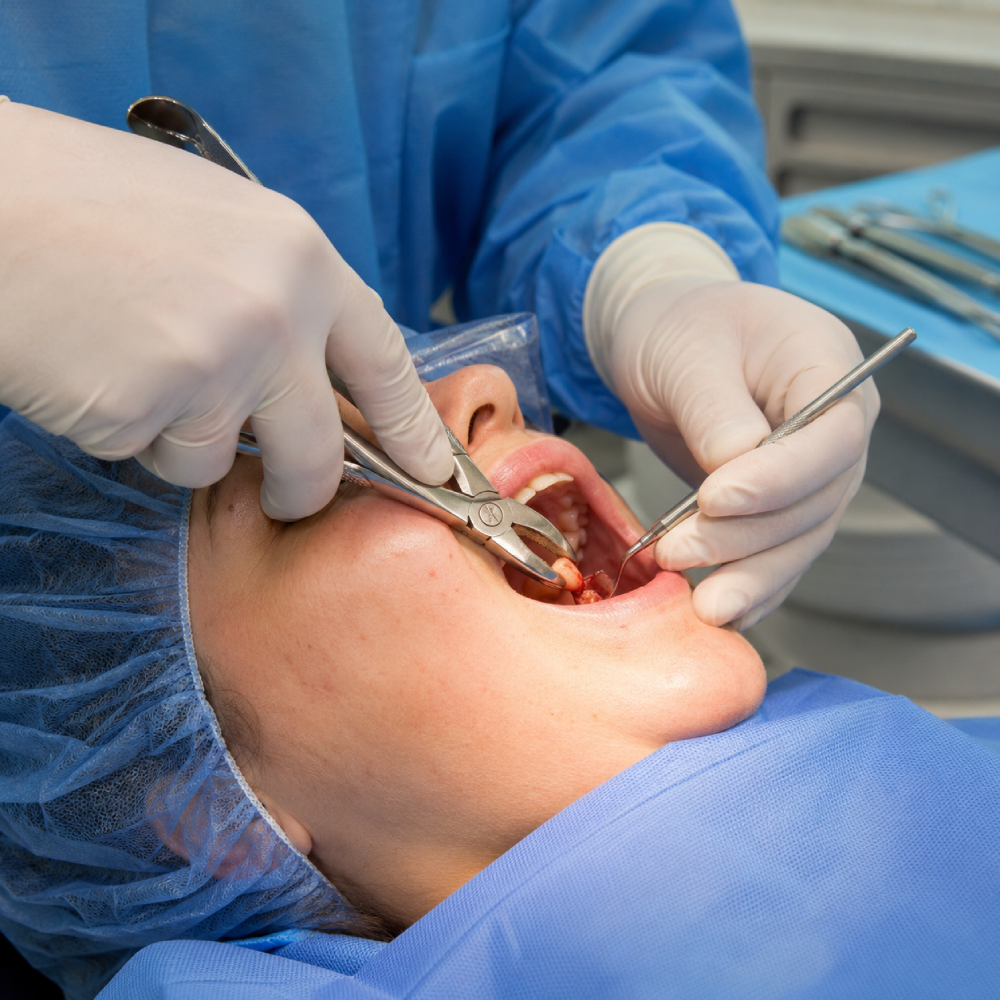 Surgical Extraction
