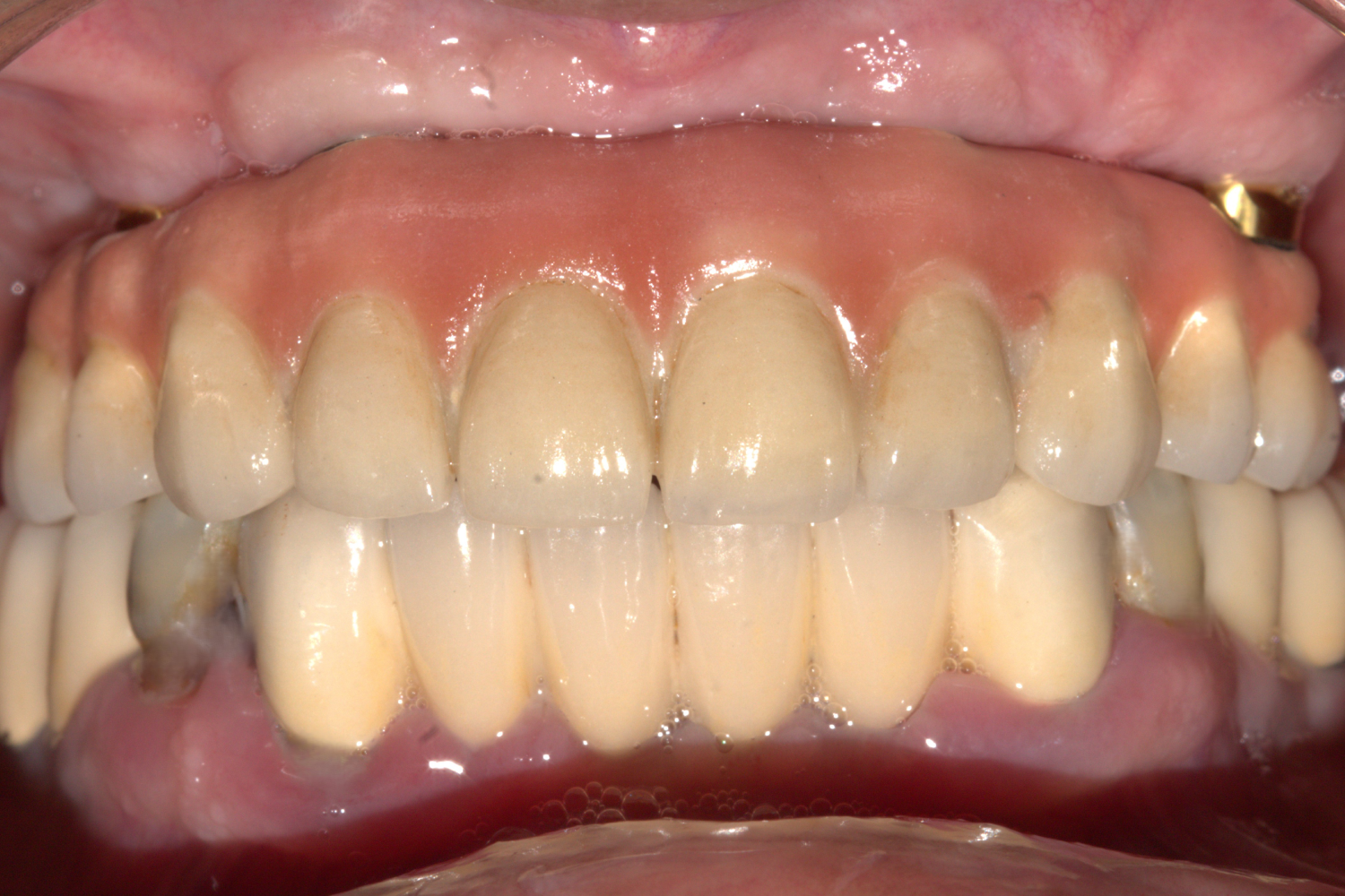 Implant after 1