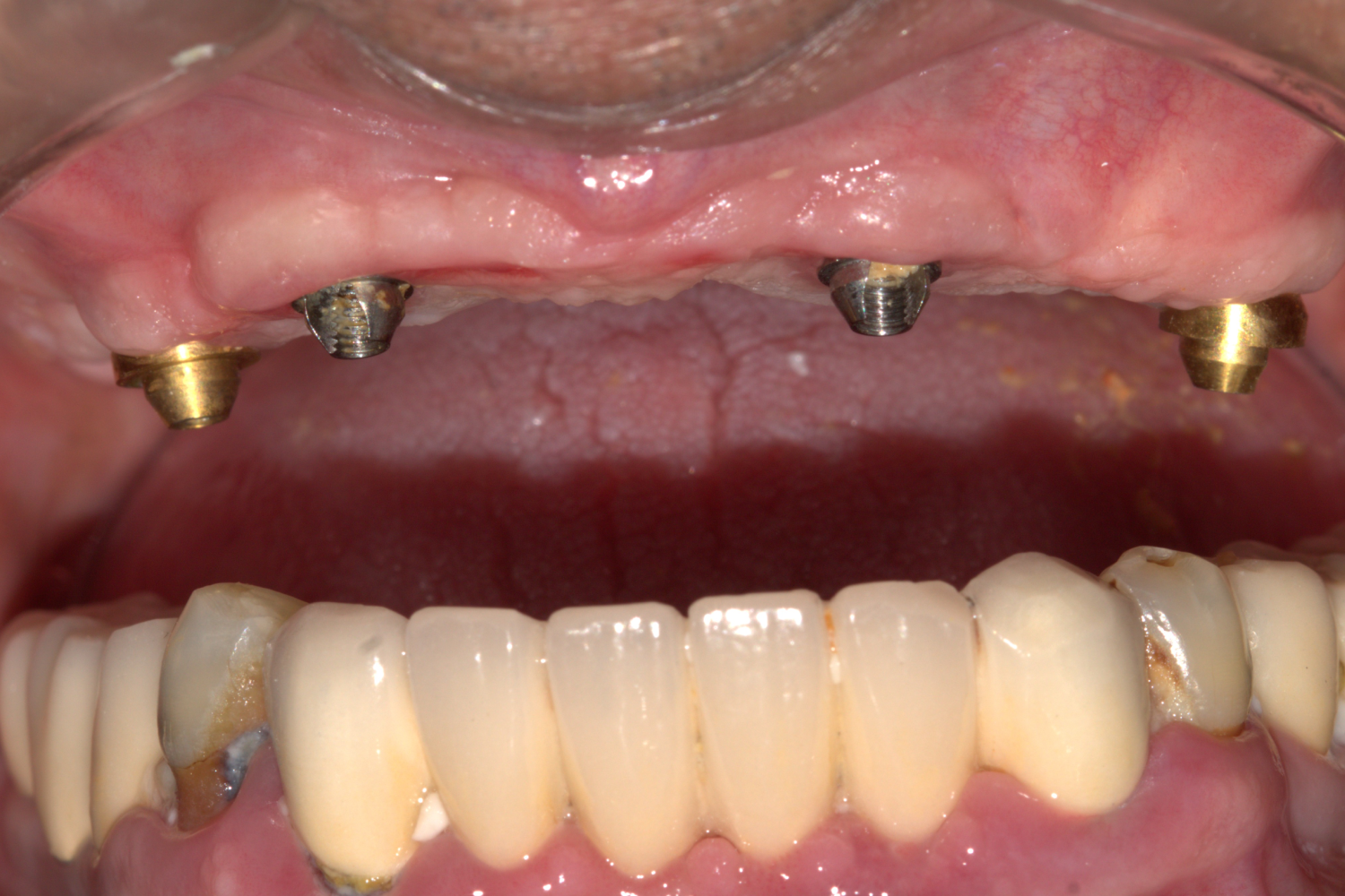 Implant after 2