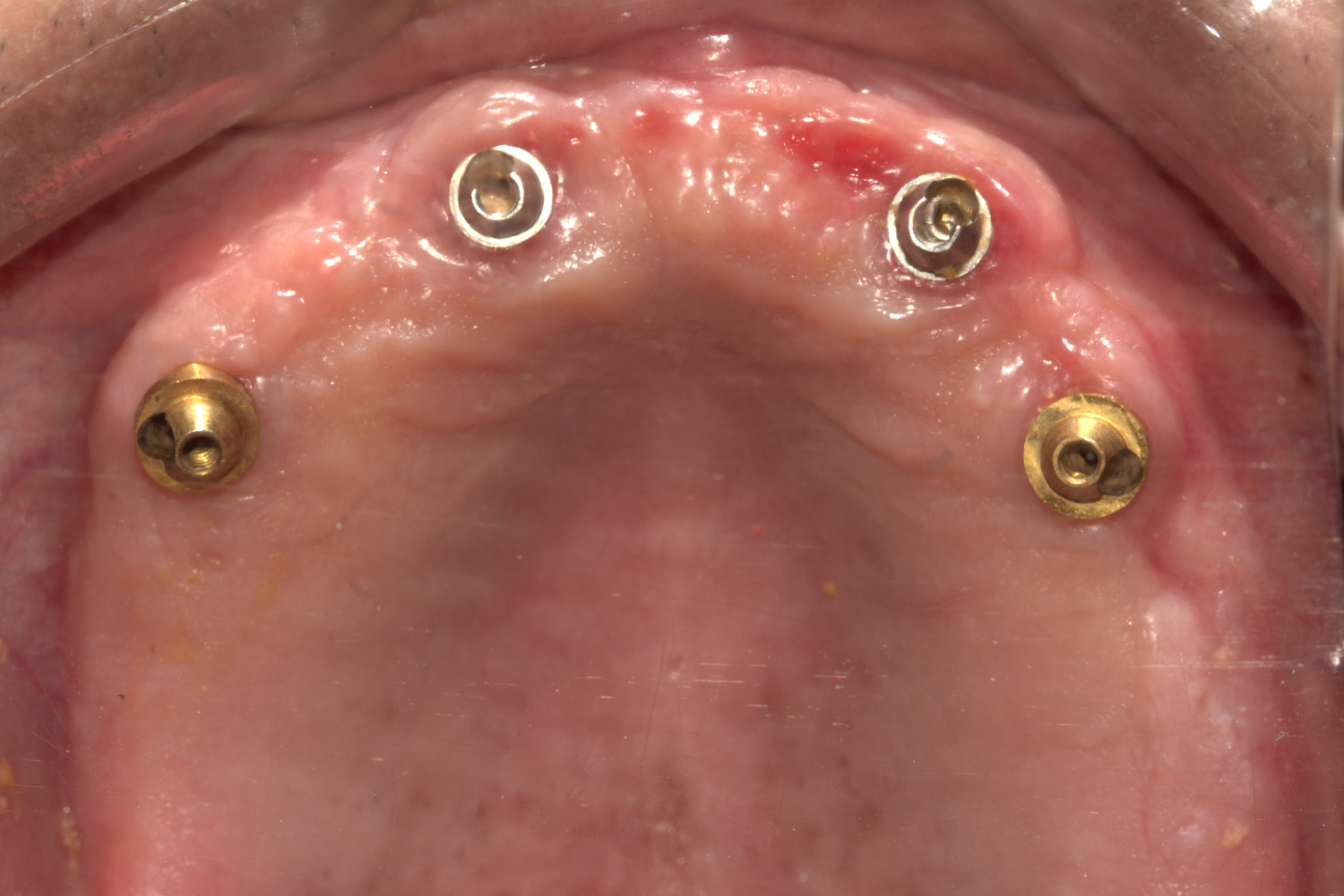 Implant after 3