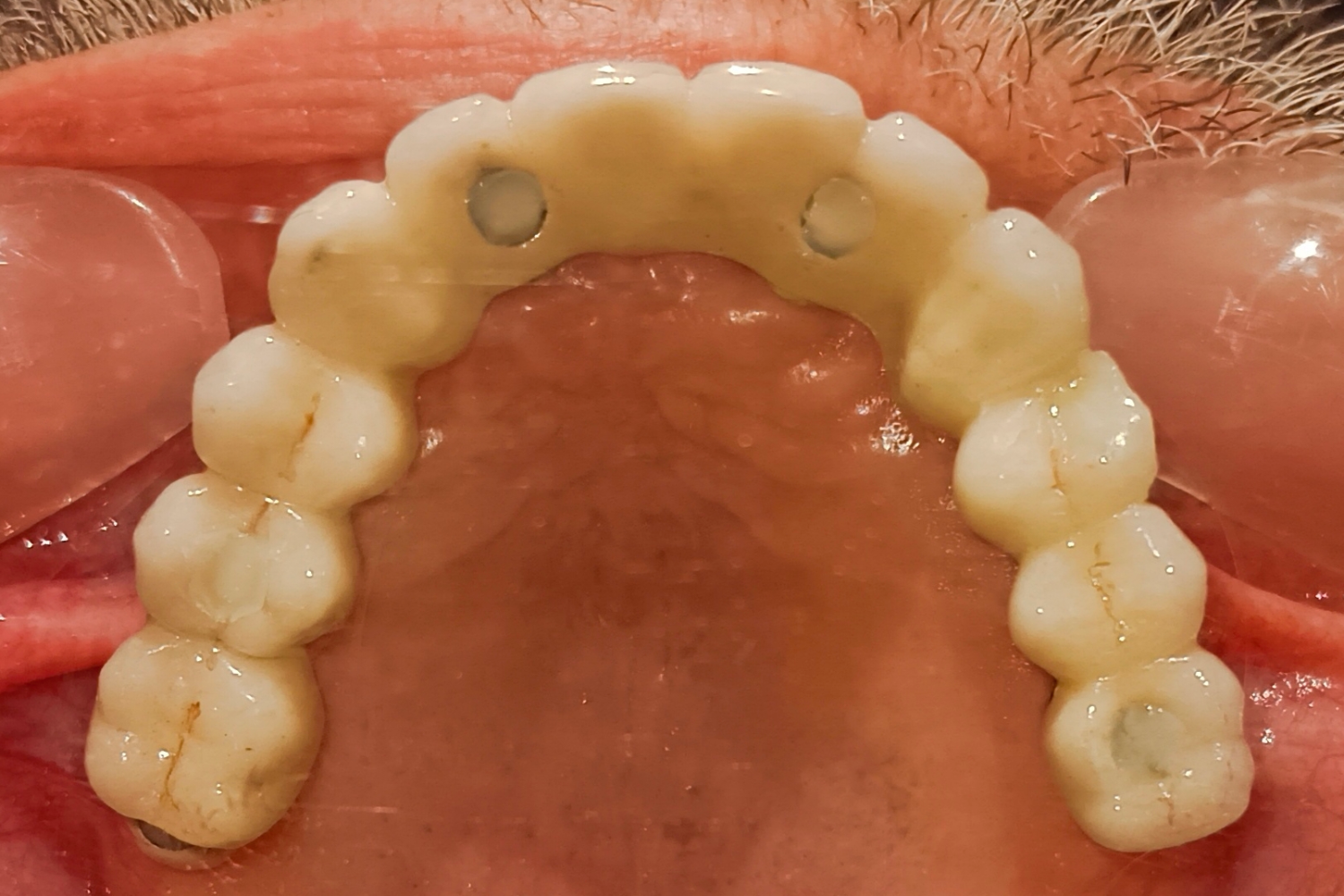 Implant after 4
