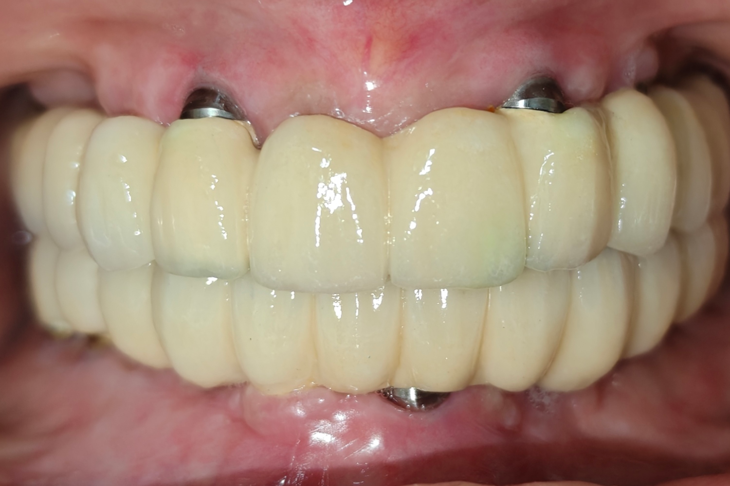 Implant after 5