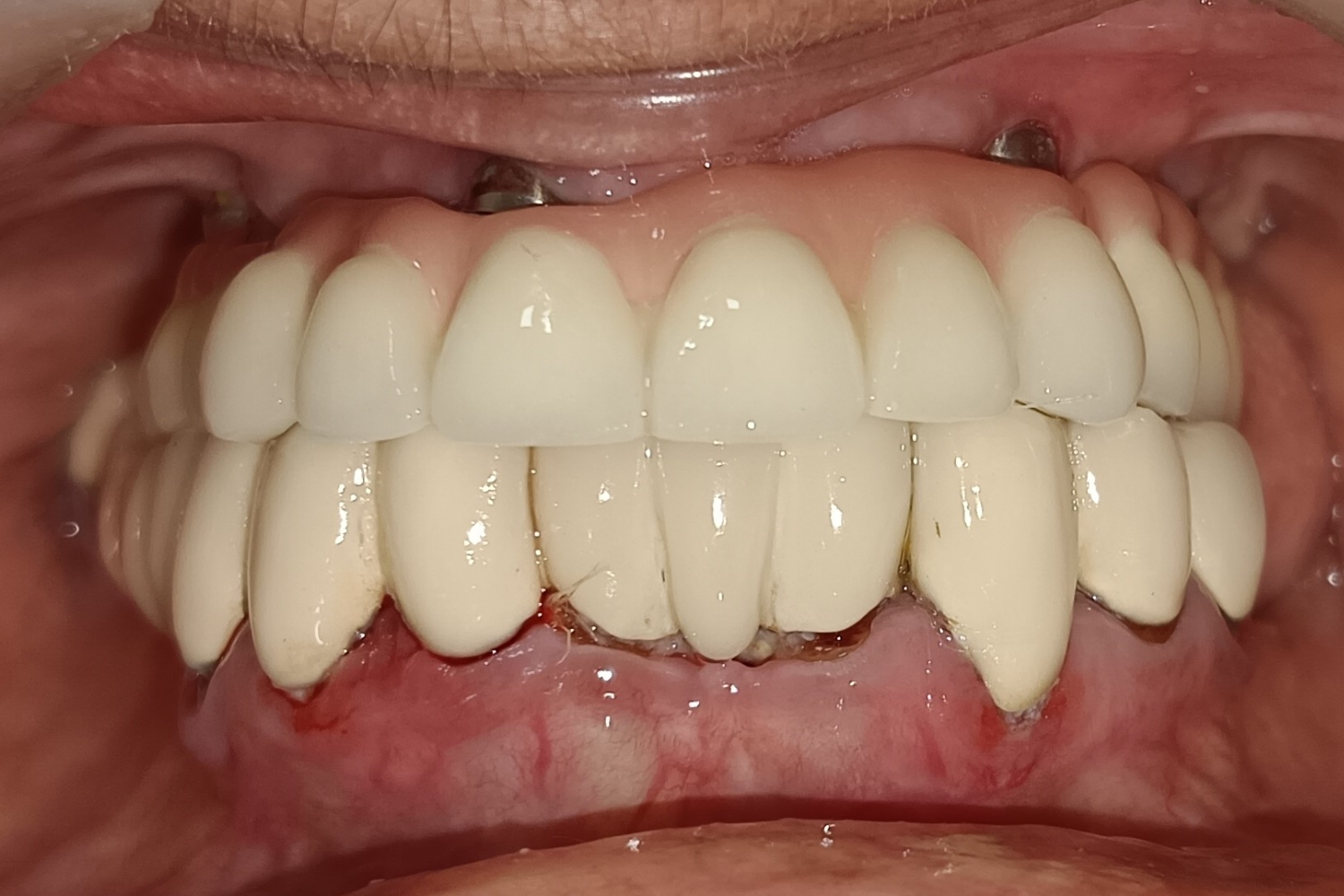 Implant after 6