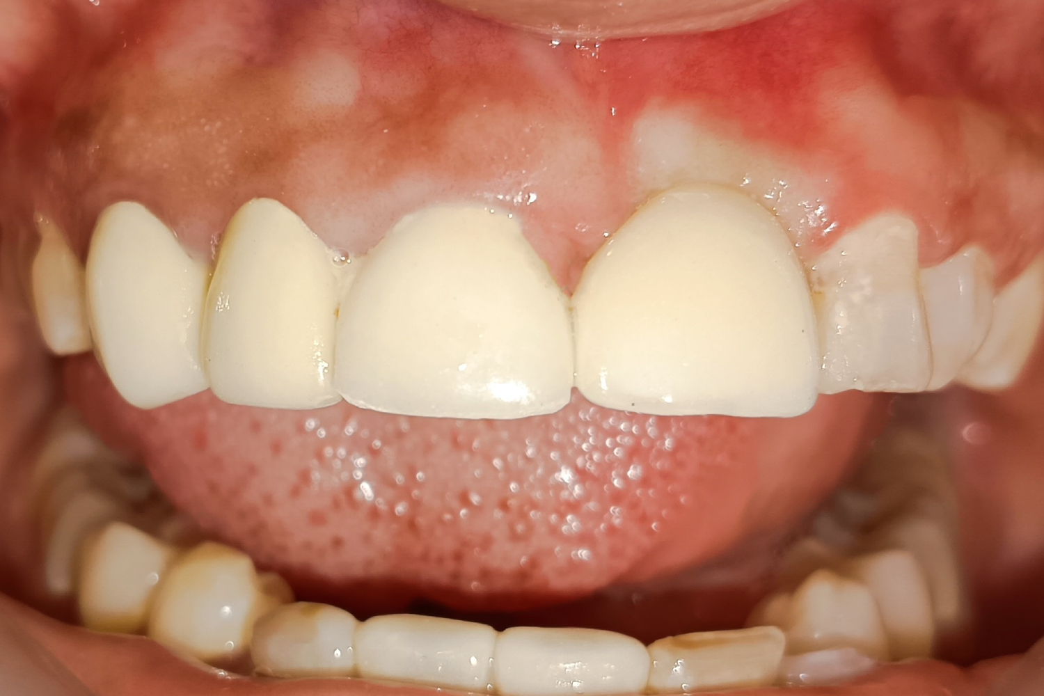 Implant after 7