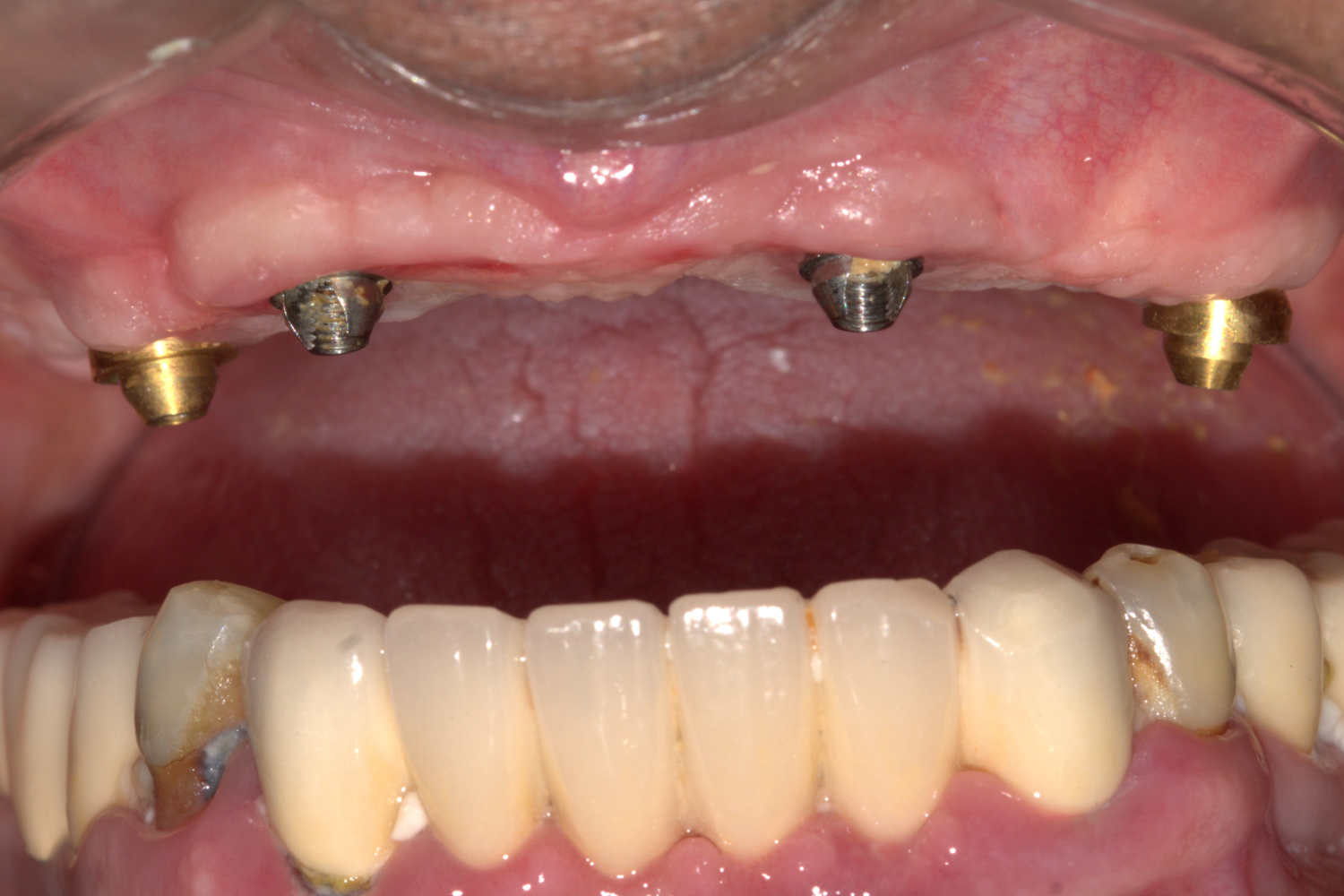 Implant before 1