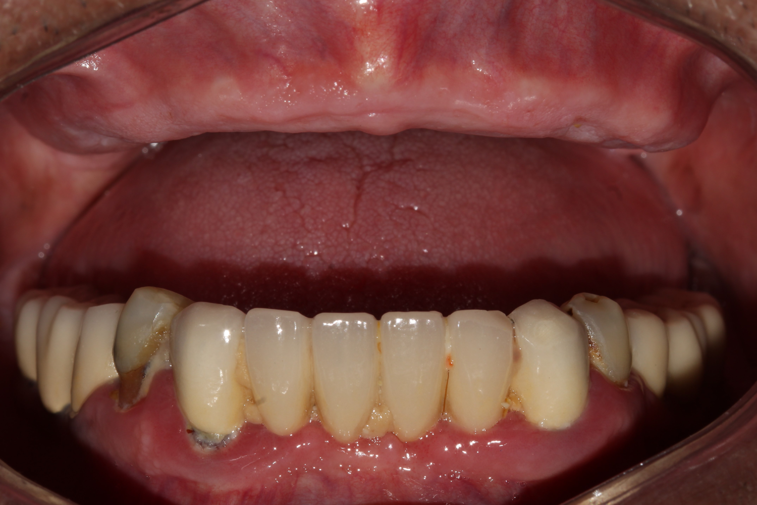 Implant before 2