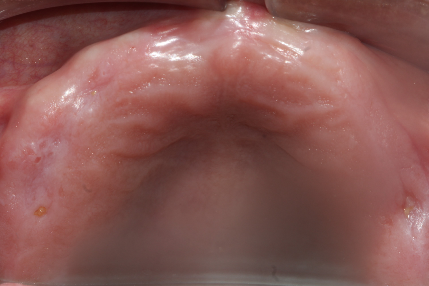 Implant before 3