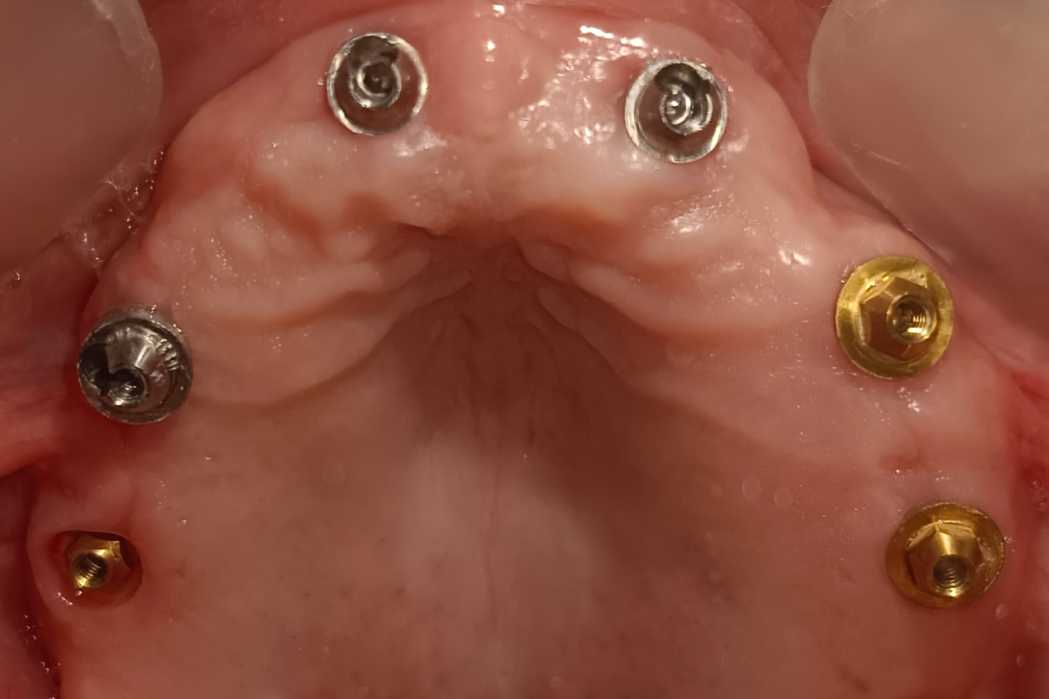 Implant before 4