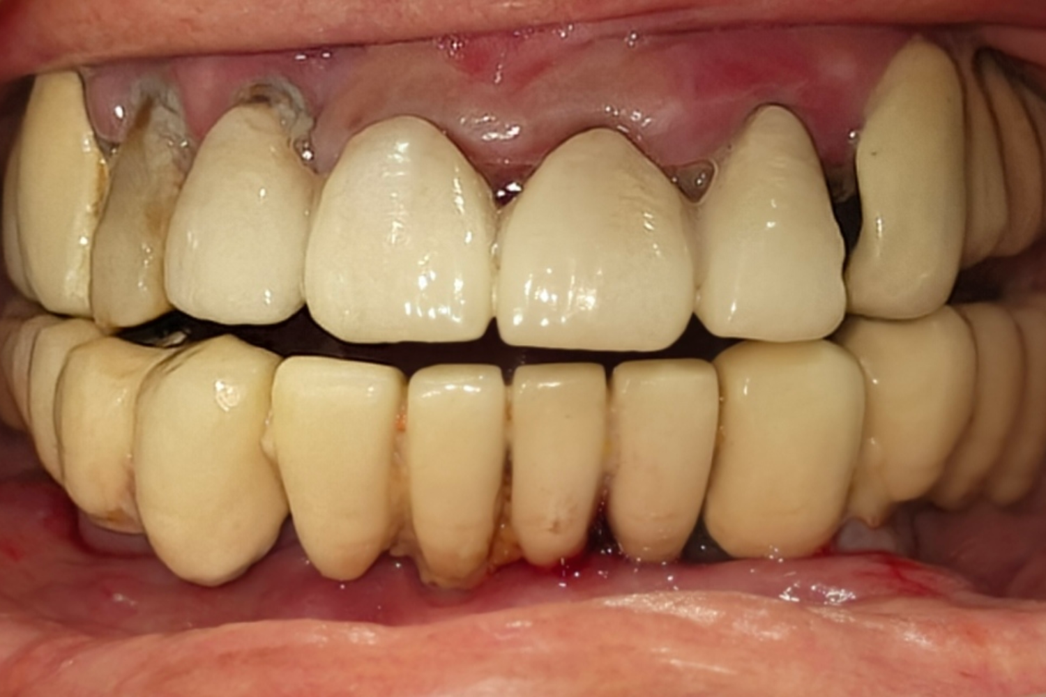 Implant before 5