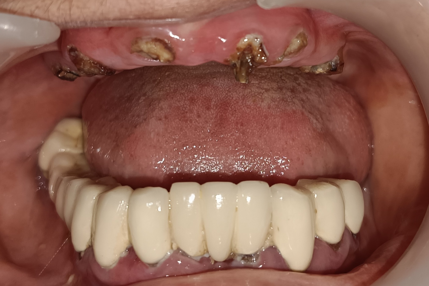 Implant before 6