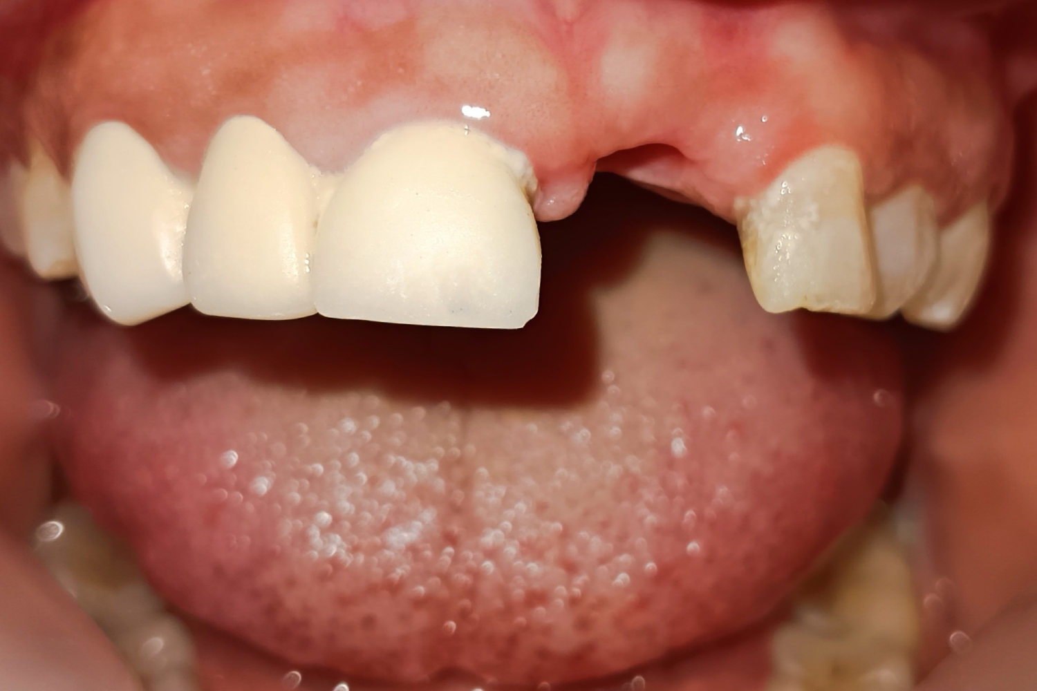 Implant before 7