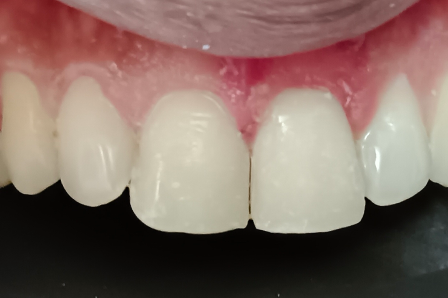 Smile Design after 1