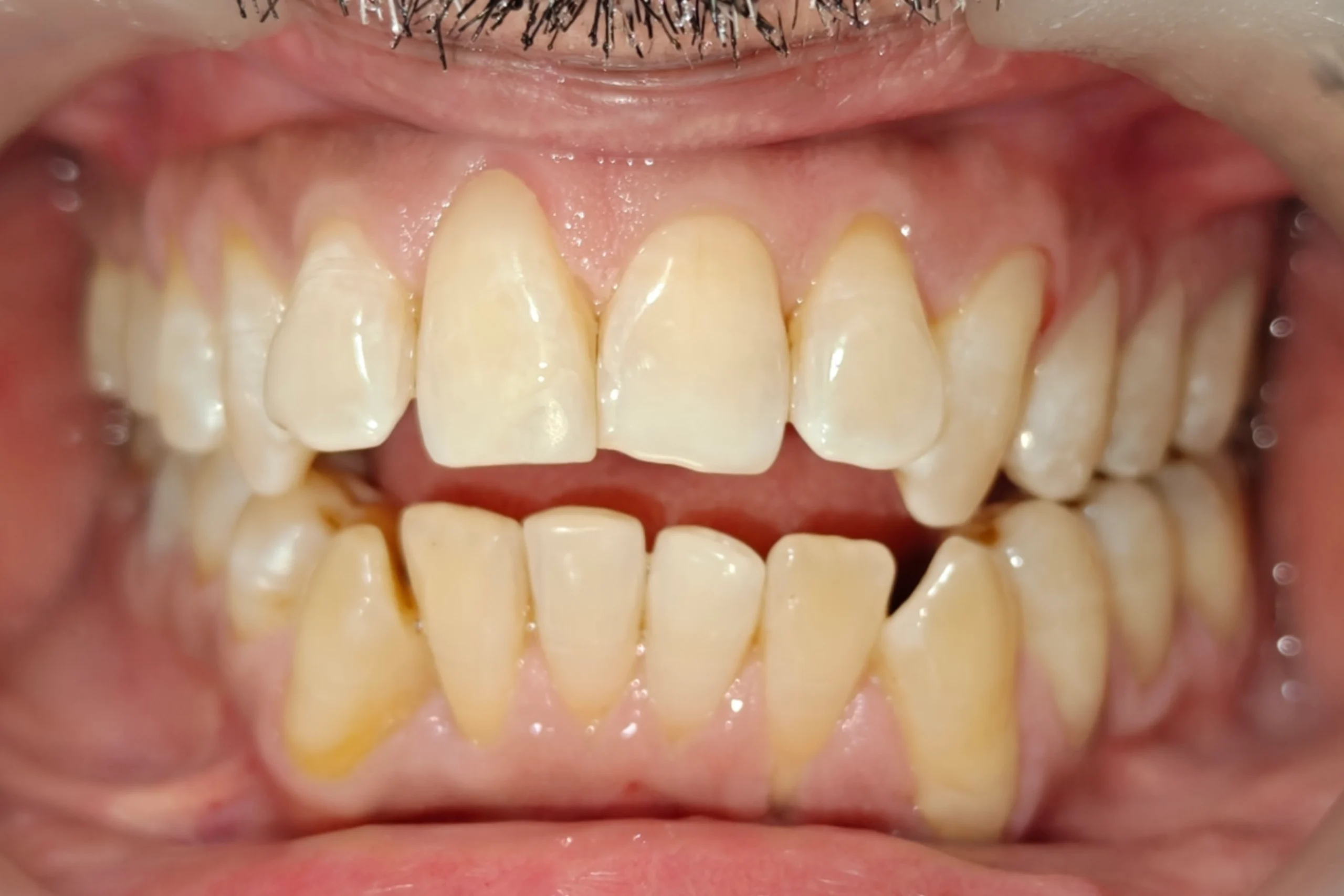 Smile Design after 10