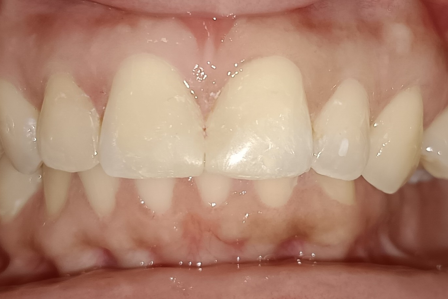Smile Design after 2