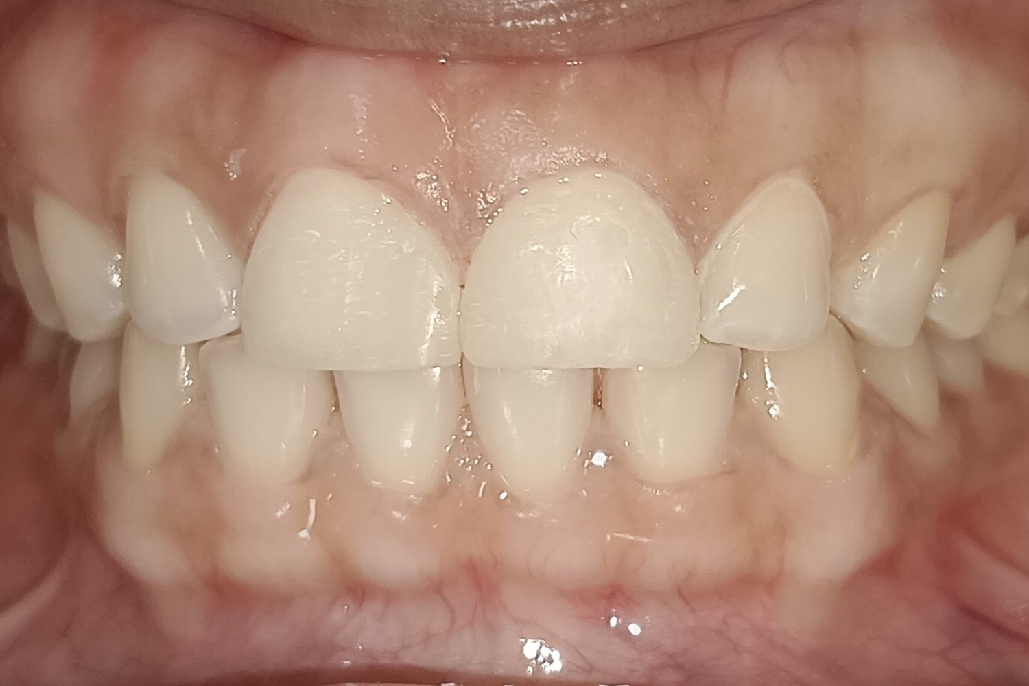 Smile Design after 3