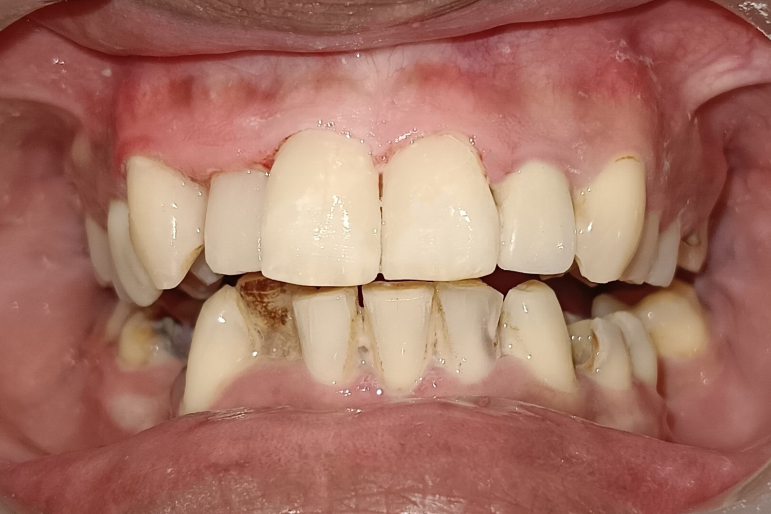 Smile Design after 4