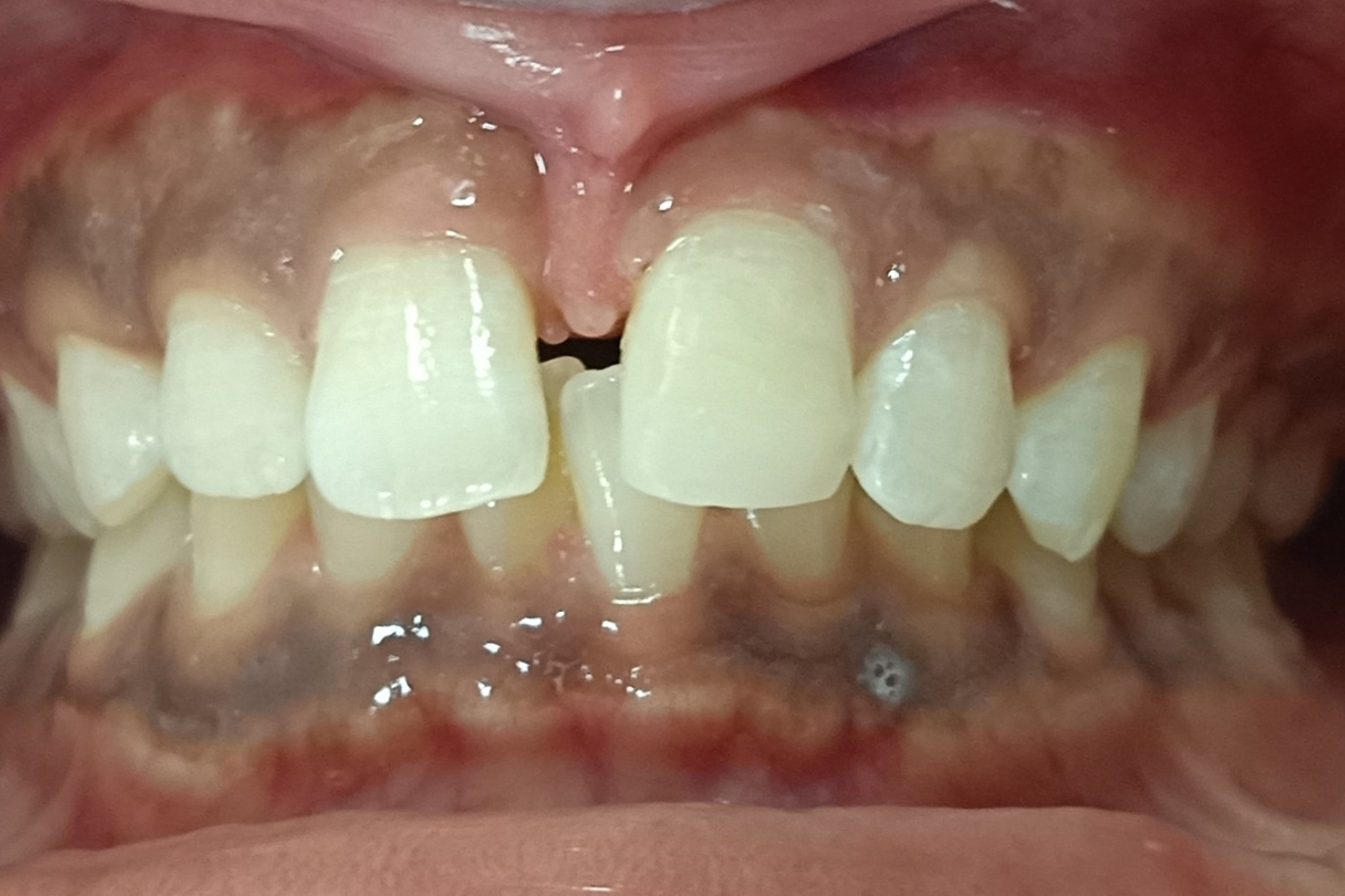 Smile Design after 5