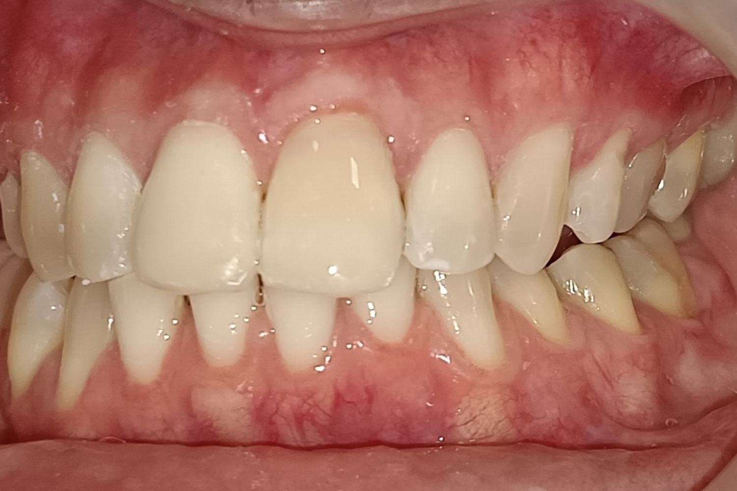 Smile Design after 6