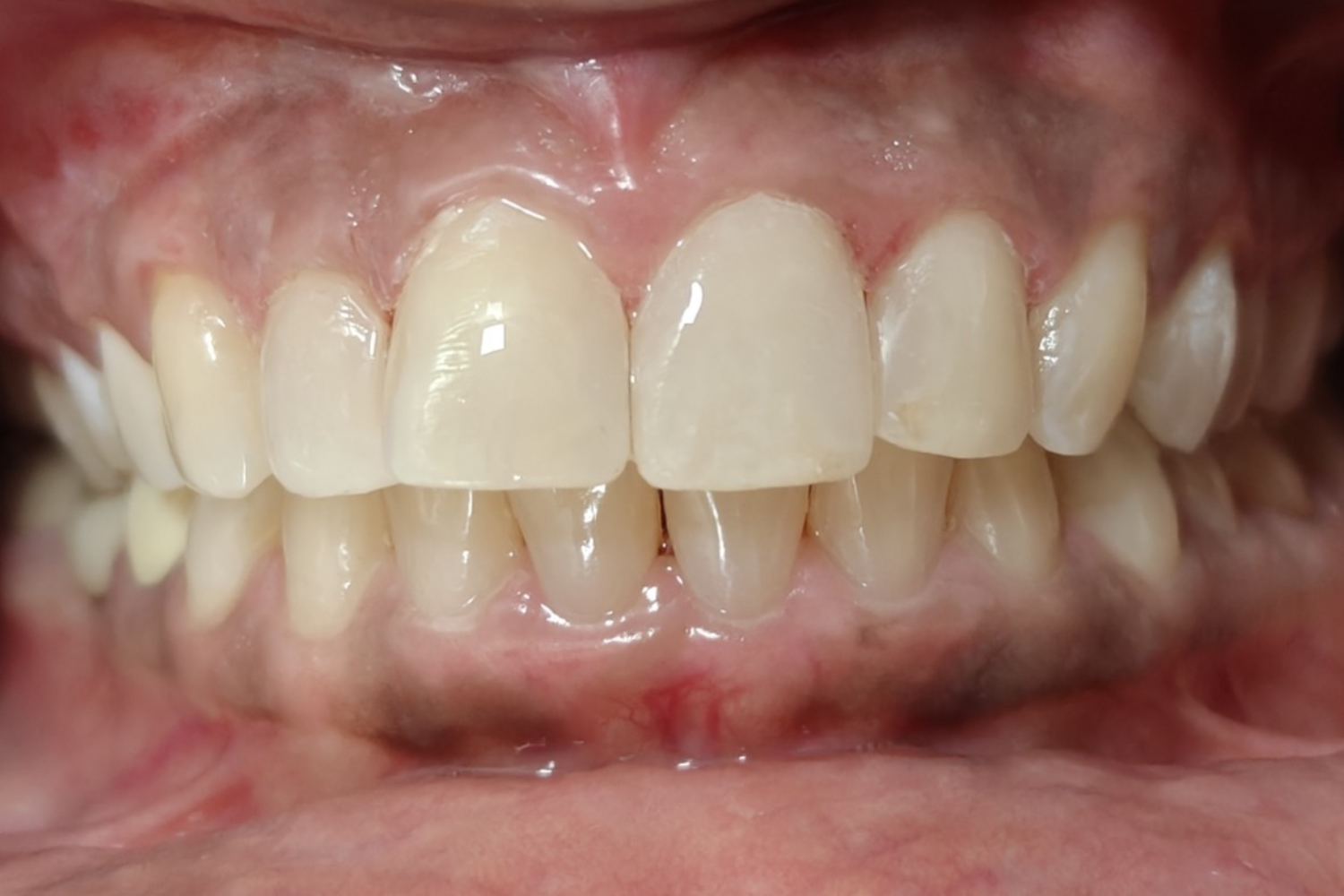 Smile Design after 7