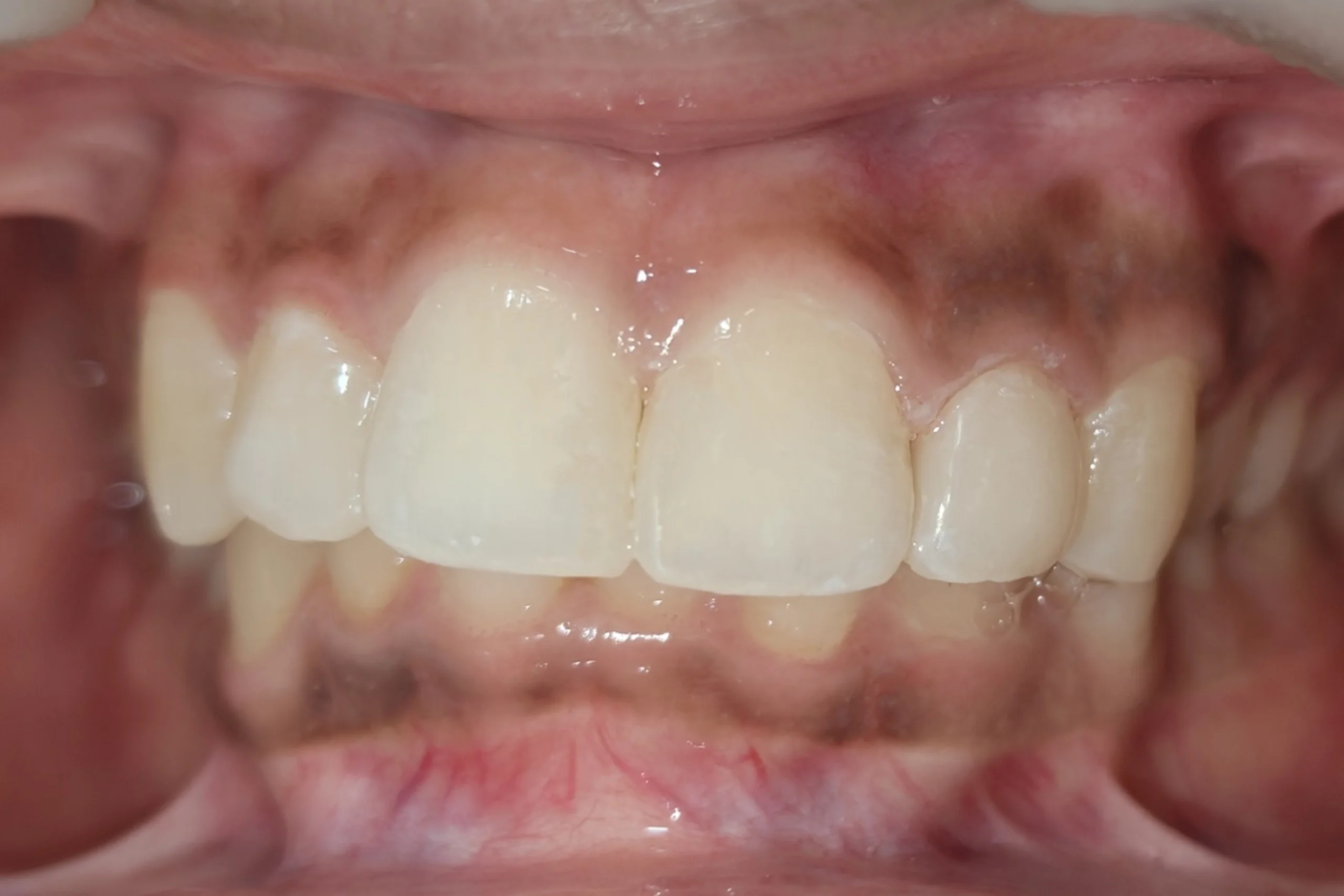 Smile Design after 8
