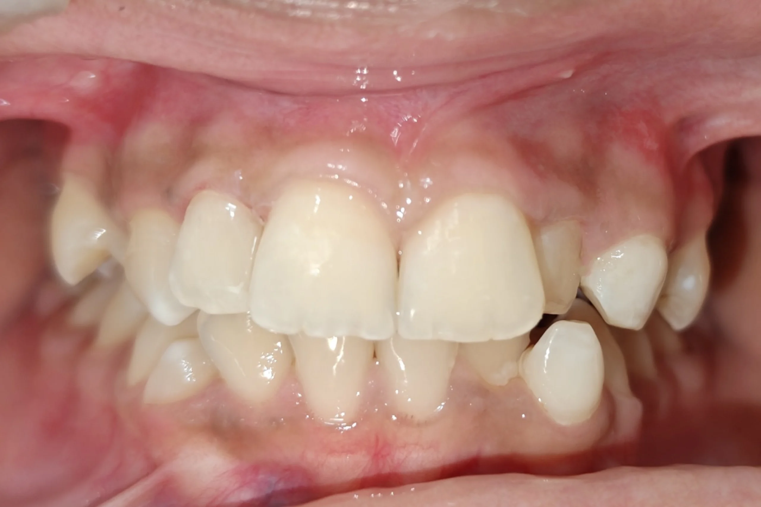 Smile Design after 9