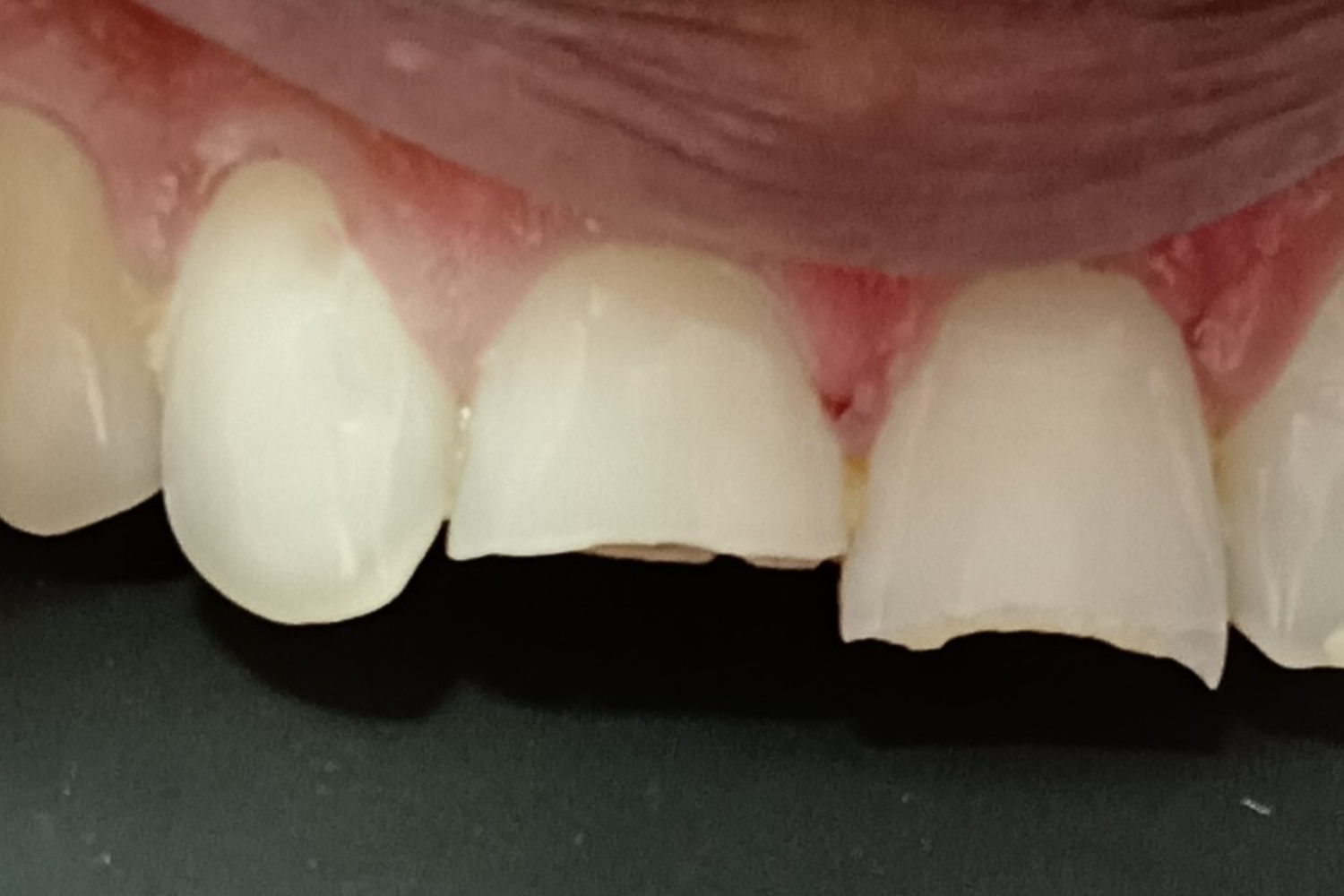 Smile Design before 1