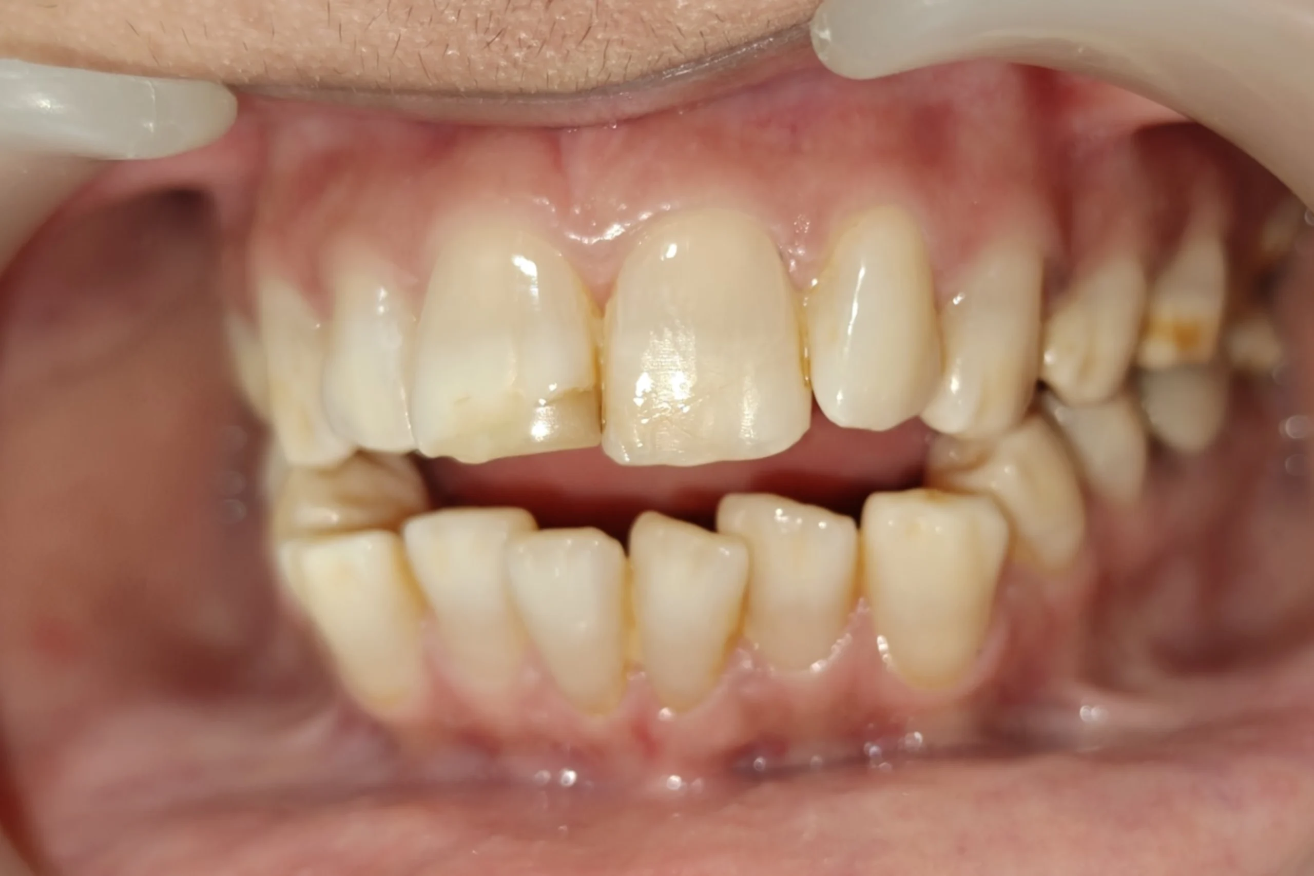 Smile Design before 10