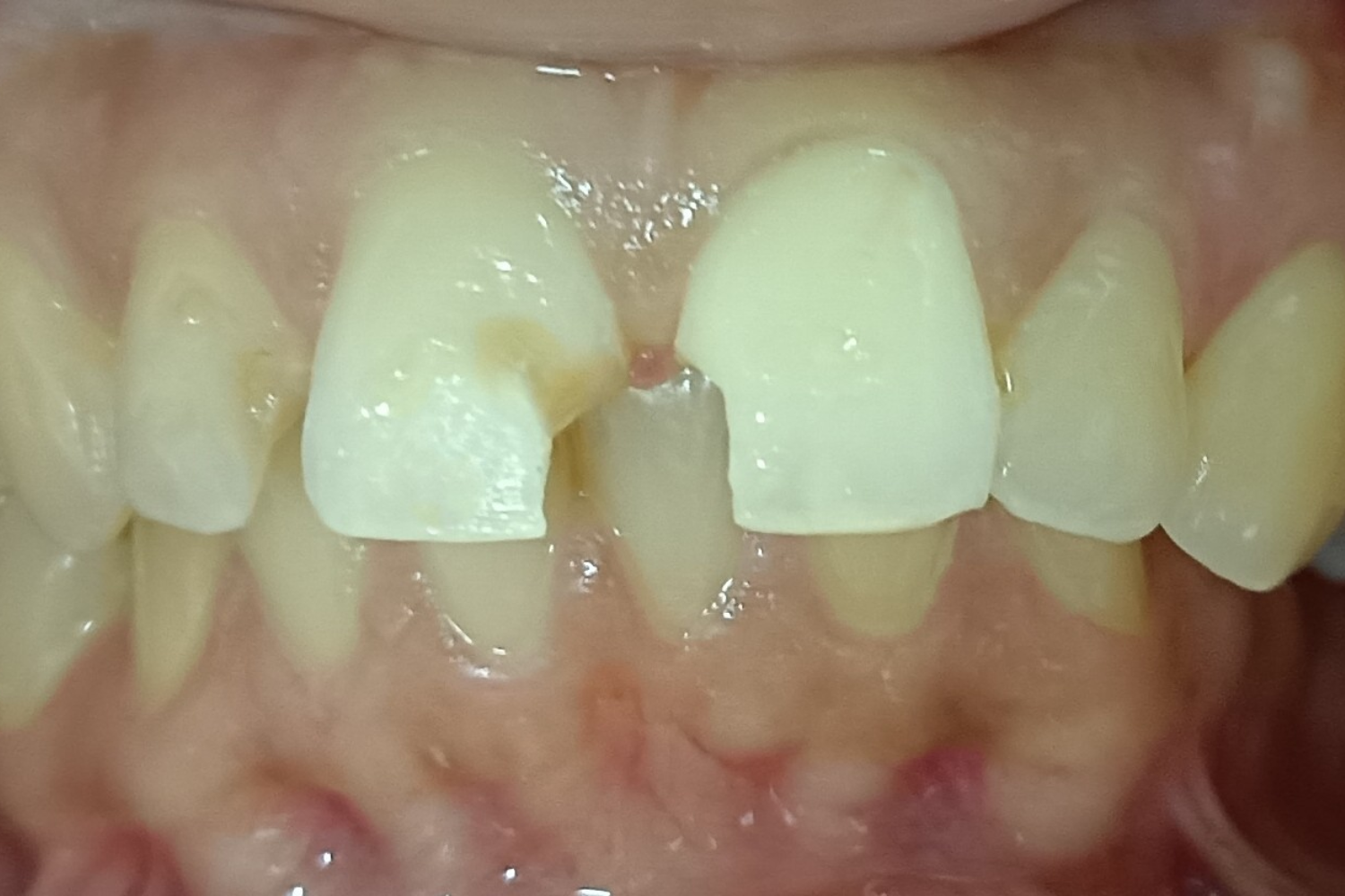 Smile Design before 2
