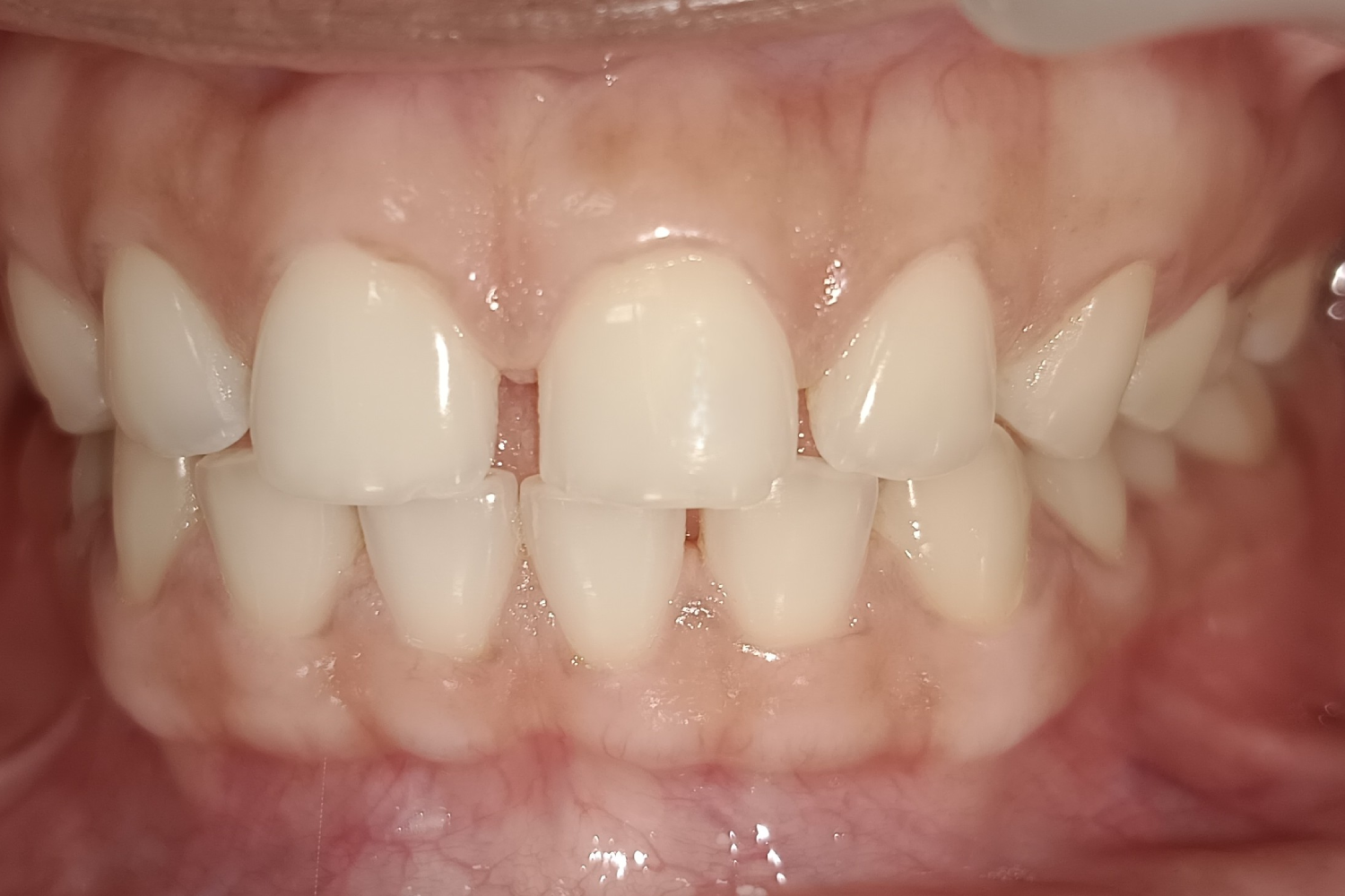 Smile Design before 3