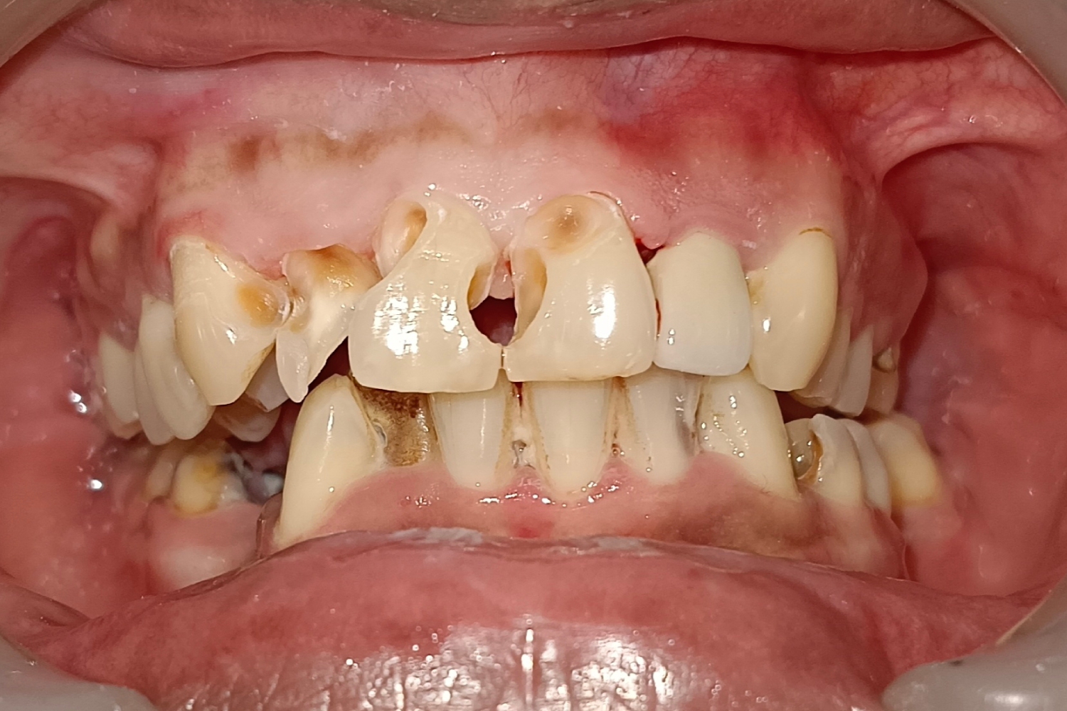 Smile Design before 4