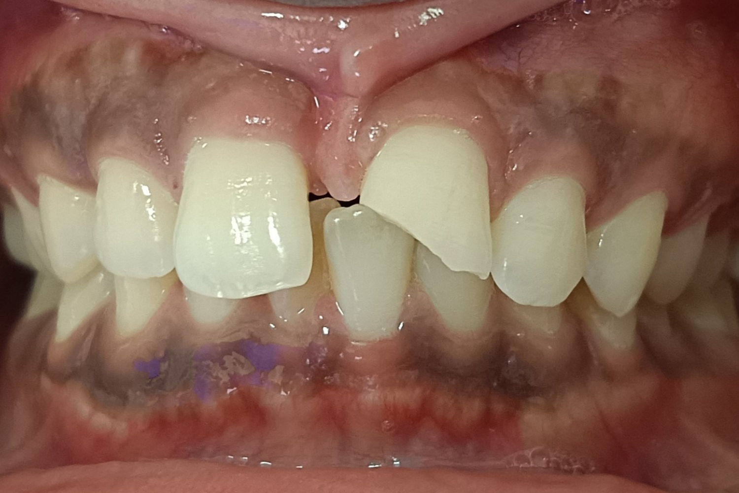 Smile Design before 5