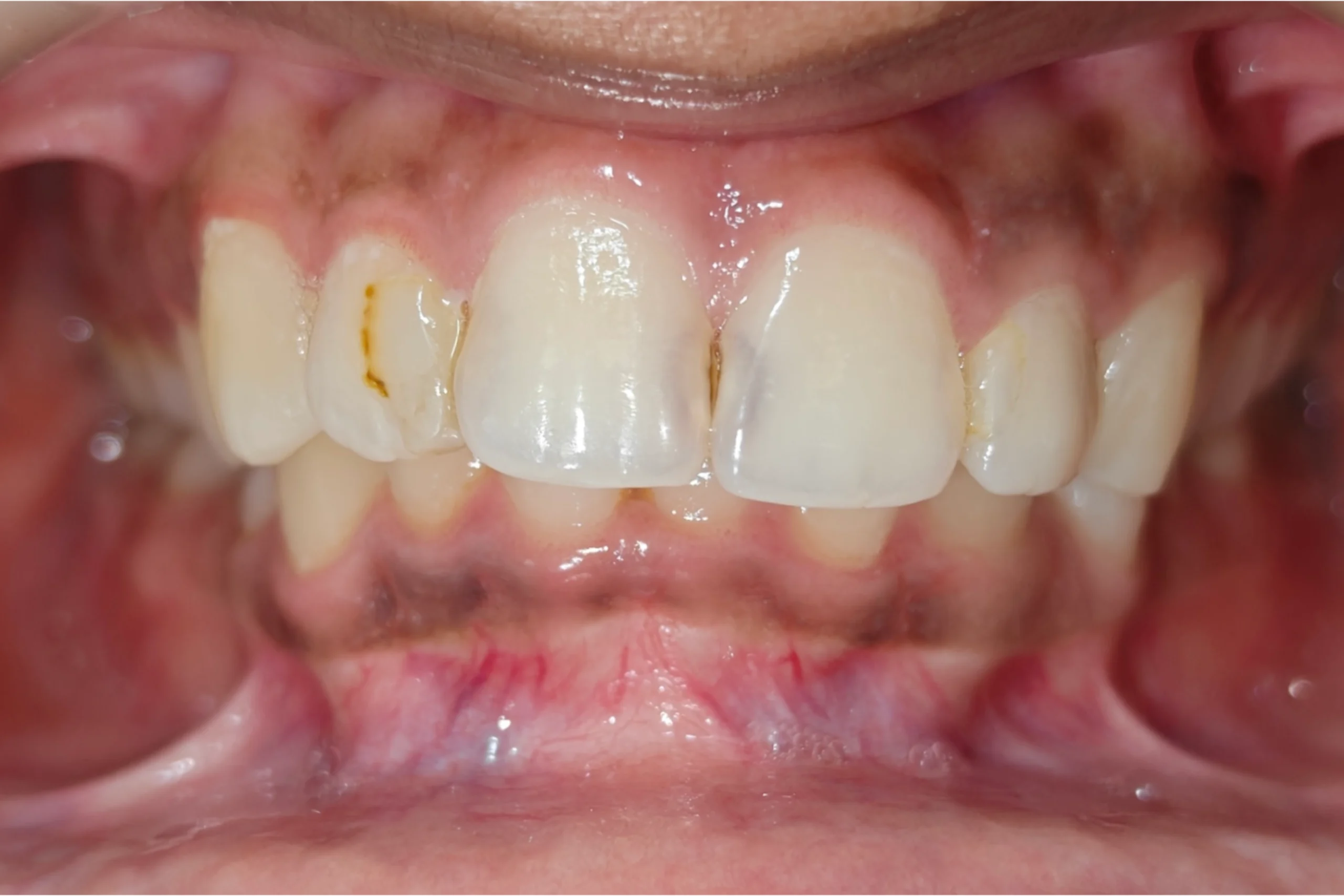 Smile Design before 8