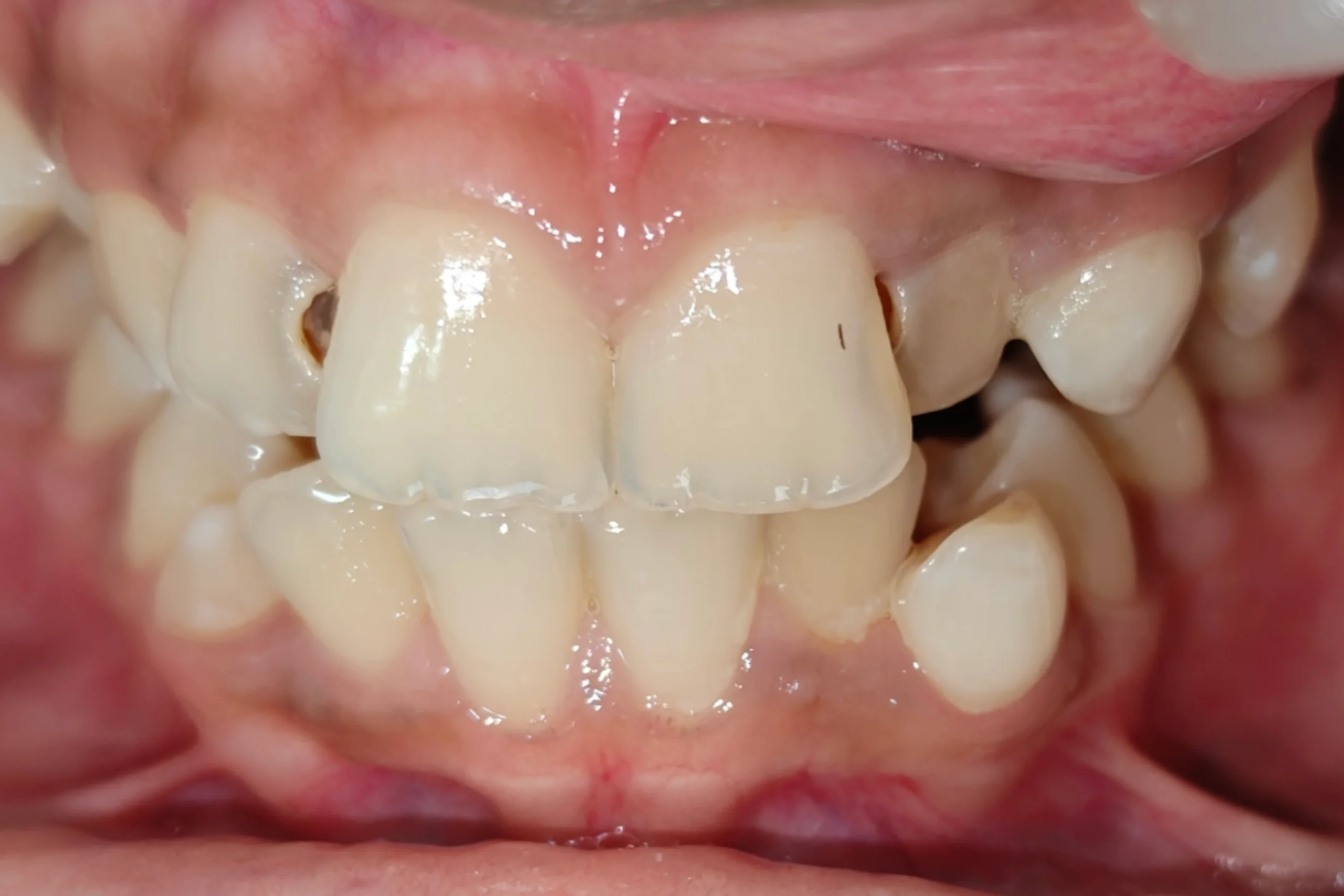 Smile Design before 9