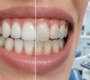 What Is Enamel Erosion And How Can You Prevent It 90x80